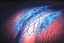 New drug-eluting stents hold promise for people with narrowed arteries, but their cost raises concerns. Image courtesy of Cordis Corp.