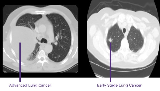 Two lung CT scans shown above illustrate the significant difference between advanced-stage lung cancer and cancer detected early. (Contributed image)